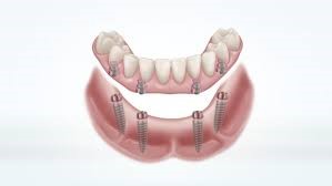 implant dentures milton keynes